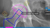 Wirtualny dobór implantów